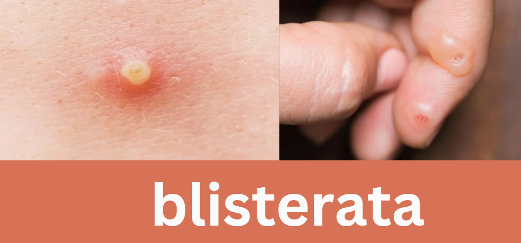 blisterata